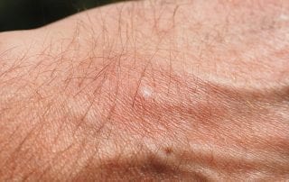 getting rid of mosquito bites